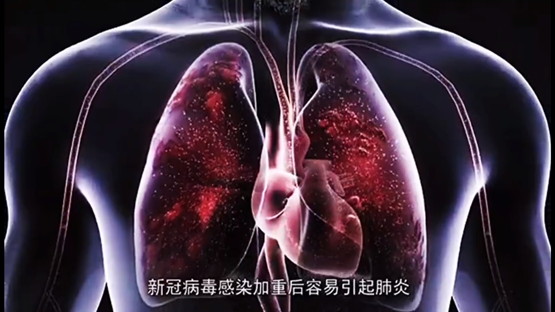 容易引起肺炎.jpg 容易引起肺炎.jpg